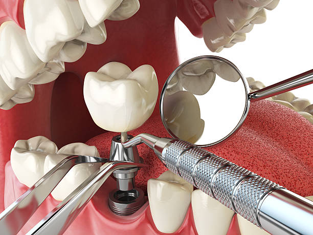 Best Emergency Wisdom Tooth Extraction in Inver Grove Heights, MN