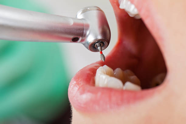 Best Knocked-Out Tooth (Avulsed Tooth) Treatment in Inver Grove Heights, MN